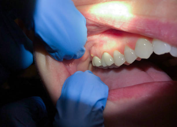 Best Emergency Wisdom Teeth Removal in Sharon, TN
