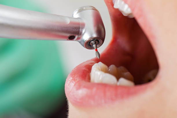 Best Emergency Tooth Extraction in Sharon, TN